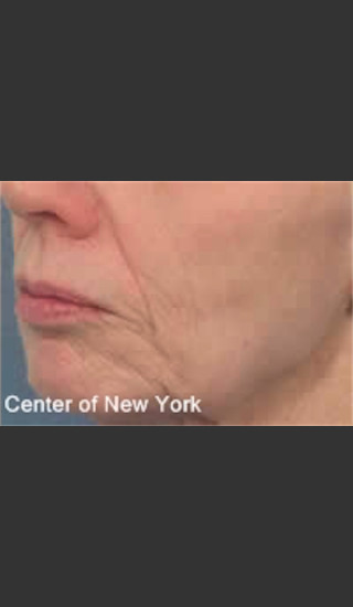 After Photo for Treatment of Fine lines and Wrinkles -  - Prejuvenation