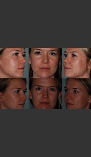 After Photo for Laser Treatment of Acne - Mark B. Taylor, M.D. - Prejuvenation