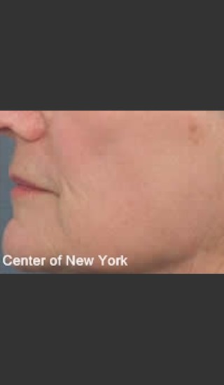 After Photo for Treatment of Lines and Wrinkles with Fraxel - Roy G. Geronemus, M.D. - Prejuvenation