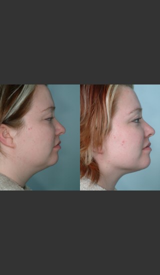 Before Photo for Submental and arm localized liposuction - Mark B. Taylor, M.D. - Prejuvenation