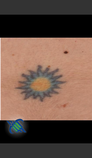 Before Photo for Treatment of Sun Tattoo - Roy G. Geronemus, M.D. - Prejuvenation
