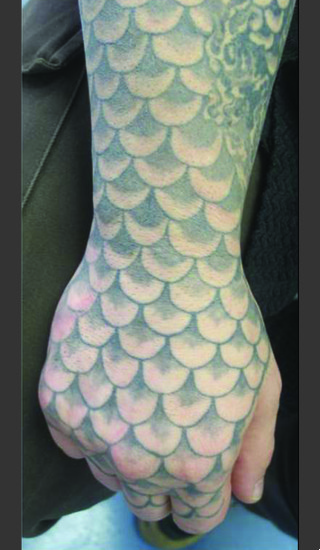 Before Photo for Quanta Q-Plus C Laser Tattoo Removal #70 -  - Prejuvenation