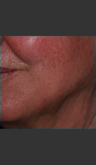 After Photo for Infini Rhytides Treatment #19 -  - Prejuvenation