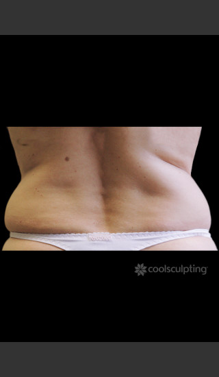 Before Photo for CoolSculpting Before & After on Woman -  - Prejuvenation