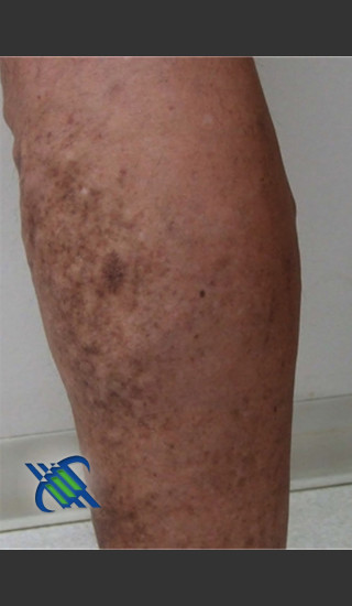 After Photo for Treatment of Lower Leg Veins - Roy G. Geronemus, M.D. - Prejuvenation