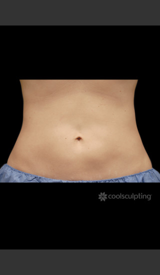 After Photo for CoolSculpting on Woman's Stomach -  - Prejuvenation