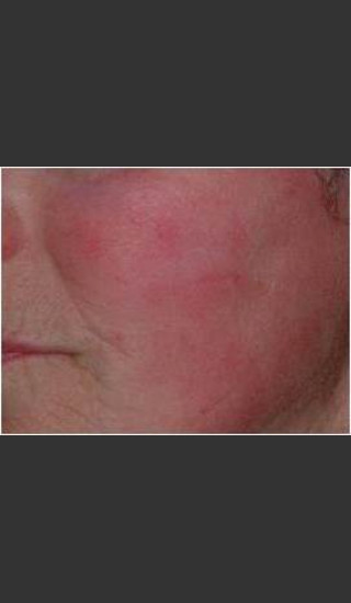 After Photo for IPL Rosacea Treatment #16 - Harvey H. Jay, M.D. - Prejuvenation