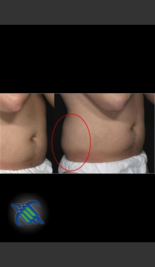 After Photo for Treatment of Right Flanks with CoolSculpting - Roy G. Geronemus, M.D. - Prejuvenation