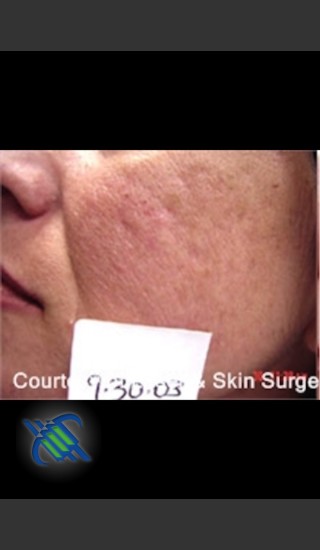 Before Photo for Treatment of Facial  Acne Scars Left Side - Roy G. Geronemus, M.D. - Prejuvenation