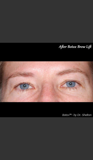 After Photo for Treatment of Perioral Wrinkles - Ron M. Shelton, M.D. - Prejuvenation