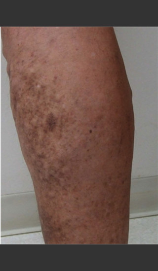 After Photo for Treatment of Leg Veins -  - Prejuvenation