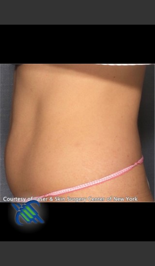 After Photo for CoolSculpting Treatment of Lower Abdomen Side On - Roy G. Geronemus, M.D. - Prejuvenation