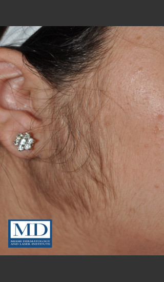 Before Photo for Laser Hair Removal 123 - Jill S. Waibel, MD - Prejuvenation