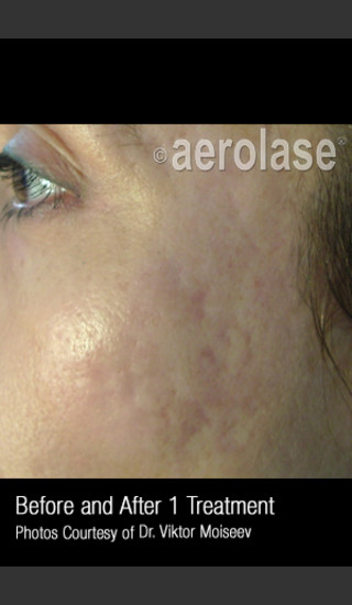 After Photo for Treatment of Acne Scars #308 -  - Prejuvenation