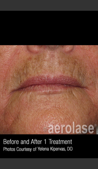 Before Photo for Treatment of Melasma #317 -  - Prejuvenation