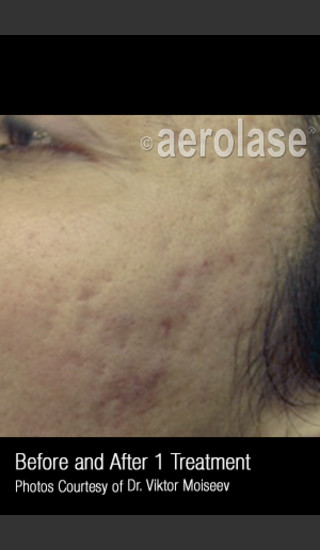 Before Photo for Treatment of Acne Scars #308 -  - Prejuvenation