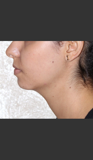 After Photo for Chin Augmentation - Bryan J. Correa, MD - Prejuvenation