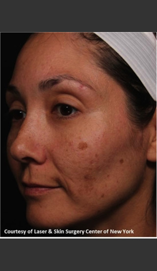 Before Photo for Full face Treament with Fraxel - Roy G. Geronemus, M.D. - Prejuvenation