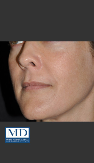 After Photo for Melasma Face Treatment 118 - Jill S. Waibel, MD - Prejuvenation