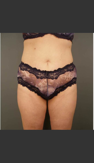 After Photo for Liposuction #44 Front View - Dr. David Amron - Prejuvenation