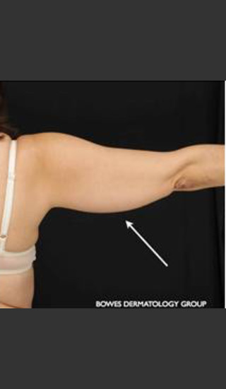 Before Photo for CoolSculpting on Woman's Upper Arm - Leyda Elizabeth Bowes, M.D. - Prejuvenation
