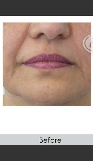 Before Photo for Marionette Line Filler - Annie Chiu, MD - Prejuvenation