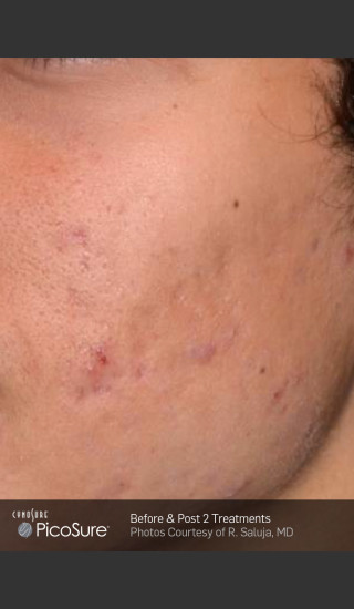 After Photo for Acne Scar Treatment with Picosure -  - Prejuvenation