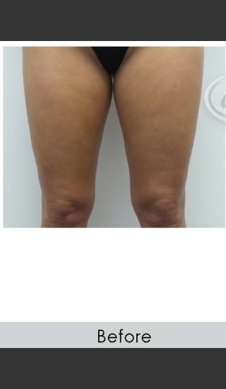Before Photo for Vanquish for Thighs - Annie Chiu, MD - Prejuvenation