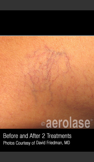 Before Photo for Treatment of Leg Veins #315 -  - Prejuvenation