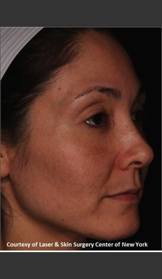 After Photo for Facial Skin Rejuvenation with Clear and Brillant Permea - Roy G. Geronemus, M.D. - Prejuvenation