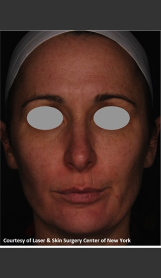 After Photo for Treatment of Facial Pigmentation -  - Prejuvenation