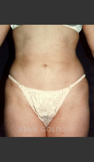 After Photo for Liposuction 439 - Alan Gold MD - Prejuvenation