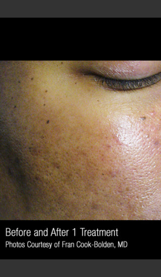 After Photo for Treatment of Facial Pigmentation #331 -  - Prejuvenation