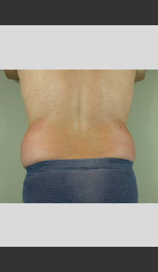 Before Photo for UltraShape Focused Ultrasound of Male Flanks -  - Prejuvenation