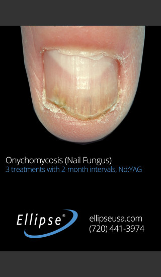 After Photo for Treatment of Toe Nail Fungus -  - Prejuvenation