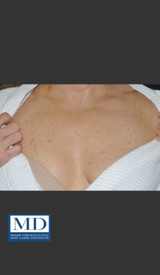 Before Photo for IPL Brown Spots Treatment 108 - Jill S. Waibel, MD - Prejuvenation