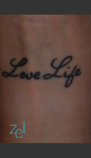 Before Photo for Laser Treatment of Forearm Tattoo - Brian D. Zelickson, M.D. - Prejuvenation