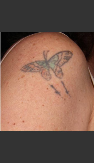 Before Photo for Treatment of Shoulder Tattoo - Roy G. Geronemus, M.D. - Prejuvenation