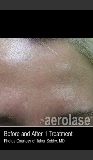 After Photo for Treatment of Pores and Skin Texture #338 -  - Prejuvenation