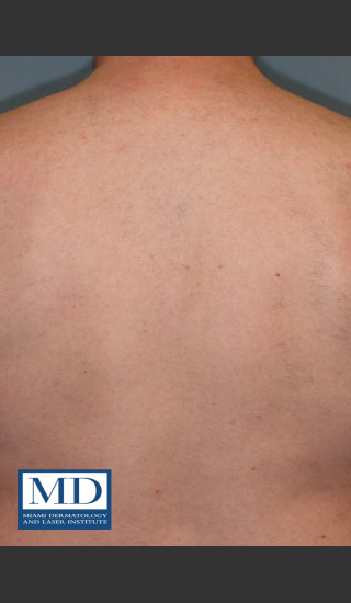 After Photo for Laser Hair Removal 122 - Jill S. Waibel, MD - Prejuvenation