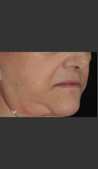 Before Photo for Radiesse and Juvederm Ultra - Leyda Elizabeth Bowes, M.D. - Prejuvenation