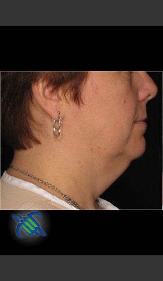 Before Photo for Laser Liposuction Left Side of Neck - Roy G. Geronemus, M.D. - Prejuvenation