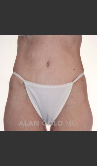 After Photo for Circumferential Body Lift 367 - Alan Gold MD - Prejuvenation