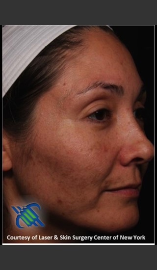 Before Photo for Facial Skin Rejuvenation of Face - Roy G. Geronemus, M.D. - Prejuvenation