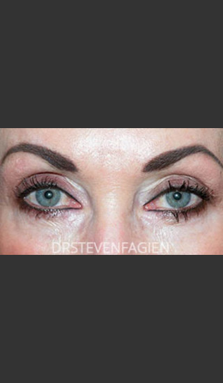 After Photo for Periorbital Rejuvenation - Patient 3 - Steven Fagien, MD - Prejuvenation