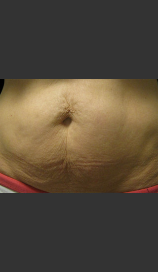 Before Photo for Body Contouring Treatment #124 -  - Prejuvenation