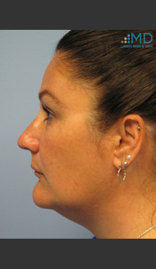 After Photo for Exilis Skin Tightening - Robert Weiss, M.D., F.A.A.D., F.A.C.Ph - Prejuvenation
