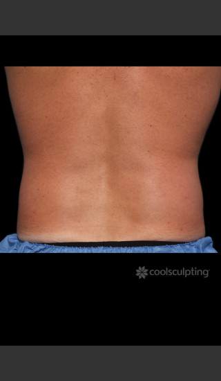 After Photo for CoolSculpting Before & After on Man -  - Prejuvenation