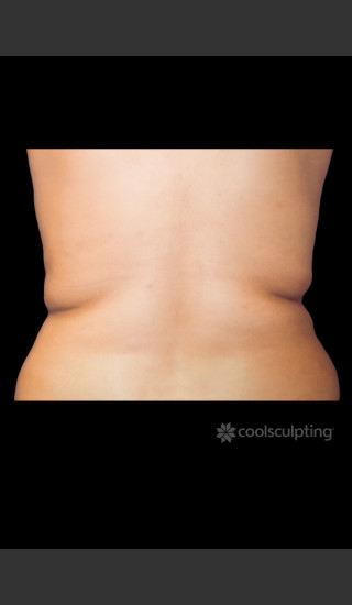 Before Photo for CoolSculpting on Woman's Flanks #1 -  - Prejuvenation