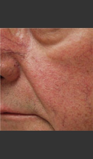 Before Photo for Dr. Langdon IPL Treatment  - Robert Langdon - Prejuvenation